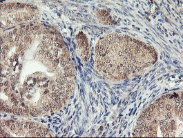 Immunohistochemical staining of paraffin-embedded Adenocarcinoma of Human endometrium tissue using anti-AGPAT5 mouse monoclonal antibody