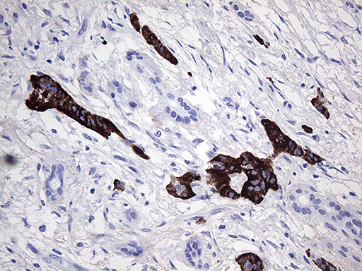 Immunohistochemical staining of paraffin-embedded Carcinoma of Human pancreas tissue using anti-ZRANB1 mouse monoclonal antibody. (Heat-induced epitope retrieval by 1mM EDTA in 10mM Tris buffer (pH8.5) at 120°C for 3min Immunohistochemical staining of paraffin-embedded Carcinoma of Human pancreas tissue using anti-ZRANB1 mouse monoclonal antibody. (Heat-induced epitope retrieval by 1mM EDTA in 10mM Tris buffer (pH8.5) at 120°C for 3min