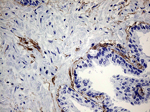 Immunohistochemical staining of paraffin-embedded Carcinoma of Human prostate tissue using anti-ZRANB1 mouse monoclonal antibody. (Heat-induced epitope retrieval by 1mM EDTA in 10mM Tris buffer (pH8.5) at 120°C for 3min Immunohistochemical staining of paraffin-embedded Carcinoma of Human prostate tissue using anti-ZRANB1 mouse monoclonal antibody. (Heat-induced epitope retrieval by 1mM EDTA in 10mM Tris buffer (pH8.5) at 120°C for 3min