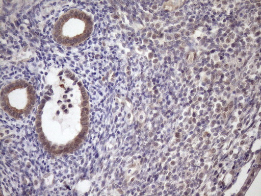 Immunohistochemical staining of paraffin-embedded Carcinoma of Human pancreas tissue using anti-SCMH1 mouse monoclonal antibody