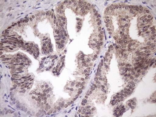 Immunohistochemical staining of paraffin-embedded Carcinoma of Human prostate tissue using anti-SCMH1 mouse monoclonal antibody