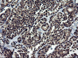 Immunohistochemical staining of paraffin-embedded Carcinoma of Human thyroid tissue using anti-NEK11 mouse monoclonal antibody