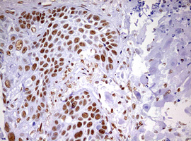 Immunohistochemical staining of paraffin-embedded Carcinoma of Human lung tissue using anti-DDX56 mouse monoclonal antibody