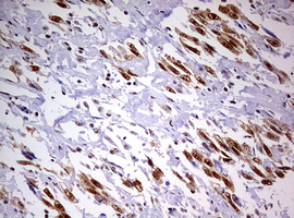 Immunohistochemical staining of paraffin-embedded Adenocarcinoma of Human ovary tissue using anti-DDX56 mouse monoclonal antibody
