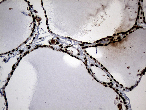 Immunohistochemical staining of paraffin-embedded Human thyroid tissue within the normal limits using anti-SF3B14 mouse monoclonal antibody