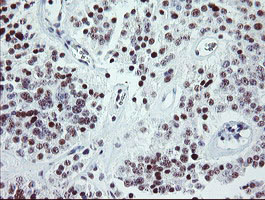 Immunohistochemical staining of paraffin-embedded Carcinoma of Human pancreas tissue using anti-ZBED1 mouse monoclonal antibody