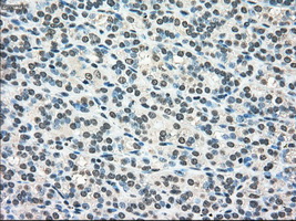 Immunohistochemical staining of paraffin-embedded Carcinoma of thyroid tissue using anti-SCYL3mouse monoclonal antibody
