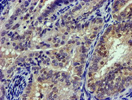 Immunohistochemical staining of paraffin-embedded Adenocarcinoma of Human endometrium tissue using anti-CAPN9 mouse monoclonal antibody
