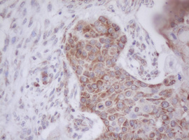 Immunohistochemical staining of paraffin-embedded Carcinoma of Human lung tissue using anti-MTIF3 mouse monoclonal antibody