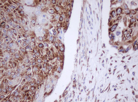 Immunohistochemical staining of paraffin-embedded Carcinoma of Human lung tissue using anti-MTIF3 mouse monoclonal antibody