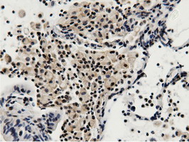 Immunohistochemical staining of paraffin-embedded Carcinoma of Human lung tissue using anti-BTN1A1 mouse monoclonal antibody