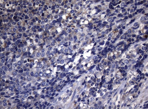 Immunohistochemical staining of paraffin-embedded Carcinoma of Human bladder tissue using anti-PITPNB mouse monoclonal antibody