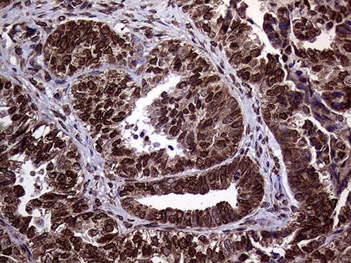 Immunohistochemical staining of paraffin-embedded Adenocarcinoma of Human endometrium tissue using anti-TRMT5 mouse monoclonal antibody