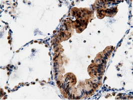 Immunohistochemical staining of paraffin-embedded Carcinoma of Human lung tissue using anti-AK5 mouse monoclonal antibody