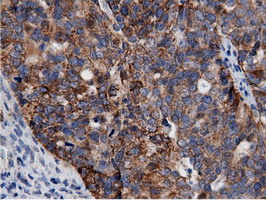 Immunohistochemical staining of paraffin-embedded Adenocarcinoma of Human ovary tissue using anti-AK5 mouse monoclonal antibody