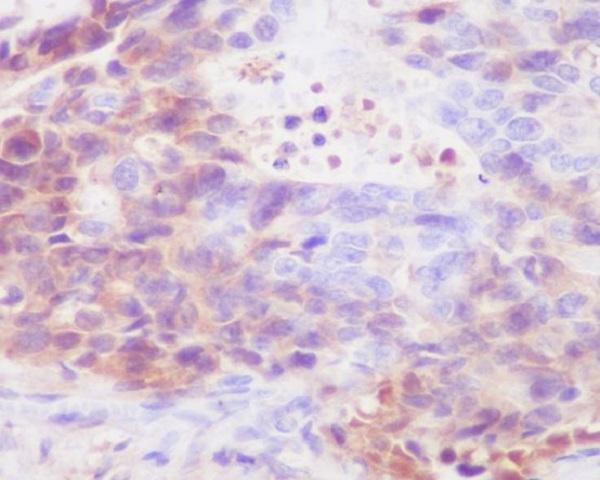 Immunohistochemical analysis of paraffin-embedded human stomach carcinoma, using human IgG4 Antibody 