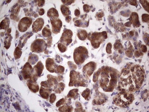 Immunohistochemical staining of paraffin-embedded Carcinoma of Human pancreas tissue using anti-CETN1 mouse monoclonal antibody