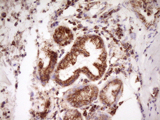 Immunohistochemical staining of paraffin-embedded Carcinoma of Human lung tissue using anti-LRRC6 mouse monoclonal antibody. (Heat-induced epitope retrieval by 1 mM EDTA in 10mM Tris Immunohistochemical staining of paraffin-embedded Carcinoma of Human lung tissue using anti-LRRC6 mouse monoclonal antibody. (Heat-induced epitope retrieval by 1 mM EDTA in 10mM Tris
