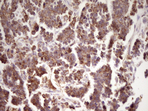 Immunohistochemical staining of paraffin-embedded Adenocarcinoma of Human ovary tissue using anti-LRRC6 mouse monoclonal antibody. (Heat-induced epitope retrieval by 1 mM EDTA in 10mM Tris Immunohistochemical staining of paraffin-embedded Adenocarcinoma of Human ovary tissue using anti-LRRC6 mouse monoclonal antibody. (Heat-induced epitope retrieval by 1 mM EDTA in 10mM Tris