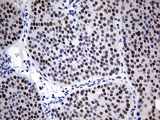 Immunohistochemical staining of paraffin-embedded Carcinoma of Human pancreas tissue using anti-ZNF2 mouse monoclonal antibody