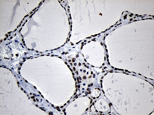Immunohistochemical staining of paraffin-embedded Human thyroid tissue within the normal limits using anti-NABP1 mouse monoclonal antibody