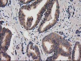 Immunohistochemical staining of paraffin-embedded Carcinoma of Human prostate tissue using anti-ACOT12 mouse monoclonal antibody
