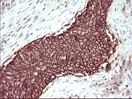 Immunohistochemical staining of paraffin-embedded Carcinoma of Human lung tissue using anti-RASSF8 mouse monoclonal antibody
