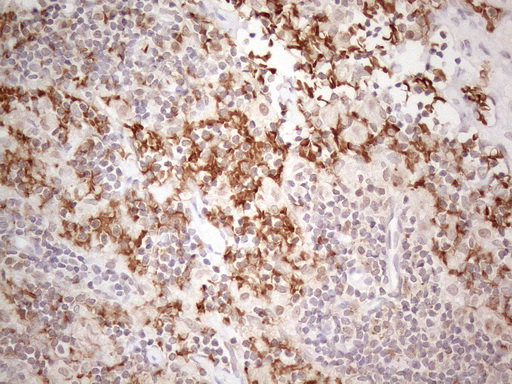 Immunohistochemical staining of paraffin-embedded Carcinoma of Human thyroid tissue using anti-PSMG2 mouse monoclonal antibody
