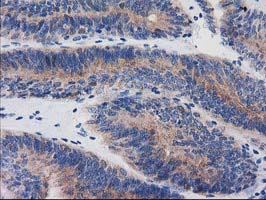 Immunohistochemical staining of paraffin-embedded Adenocarcinoma of Human endometrium tissue using anti-BIN3 mouse monoclonal antibody