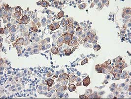 Immunohistochemical staining of paraffin-embedded Carcinoma of Human lung tissue using anti-FAM119A mouse monoclonal antibody
