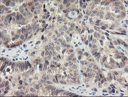 Immunohistochemical staining of paraffin-embedded Adenocarcinoma of Human ovary tissue using anti-MEIS3 mouse monoclonal antibody