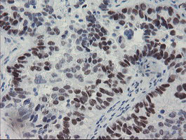 Immunohistochemical staining of paraffin-embedded Adenocarcinoma of Human ovary tissue using anti-MEIS3 mouse monoclonal antibody