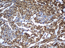 Immunohistochemical staining of paraffin-embedded Carcinoma of Human thyroid tissue using anti-ZFAND5 mouse monoclonal antibody. (Heat-induced epitope retrieval by 10mM citric buffer