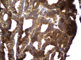 Immunohistochemical staining of paraffin-embedded Adenocarcinoma of Human endometrium tissue using anti-CCDC93 mouse monoclonal antibody