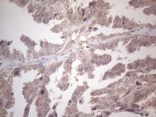 Immunohistochemical staining of paraffin-embedded Adenocarcinoma of Human ovary tissue using anti-B4GALT4 mouse monoclonal antibody