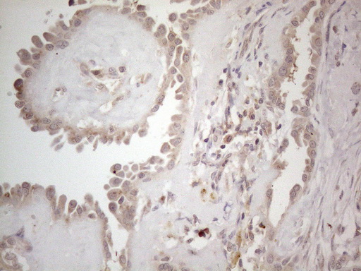 Immunohistochemical staining of paraffin-embedded Carcinoma of Human thyroid tissue using anti-B4GALT4 mouse monoclonal antibody