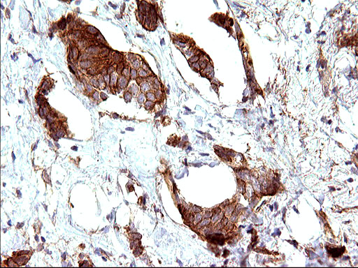 Immunohistochemical staining of paraffin-embedded Adenocarcinoma of Human breast tissue using anti-HAUS7 mouse monoclonal antibody