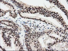 Immunohistochemical staining of paraffin-embedded Carcinoma of Human prostate tissue using anti-EPM2AIP1 mouse monoclonal antibody at 1:150 (M12427-2)