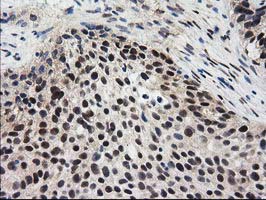 Immunohistochemical staining of paraffin-embedded Carcinoma of Human bladder tissue using anti-EPM2AIP1 mouse monoclonal antibody at 1:150 (M12427-2)