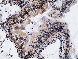 Immunohistochemical staining of paraffin-embedded Carcinoma of Human lung tissue using anti-EPM2AIP1 mouse monoclonal antibody