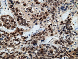 Immunohistochemical staining of paraffin-embedded Adenocarcinoma of Human ovary tissue using anti-EPM2AIP1 mouse monoclonal antibody
