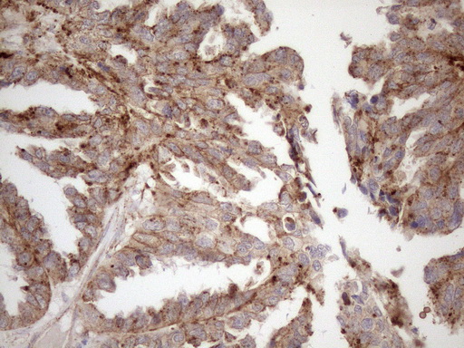 Immunohistochemical staining of paraffin-embedded Adenocarcinoma of Human ovary tissue using anti-KCTD9 mouse monoclonal antibody