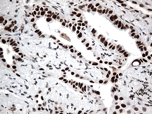 Immunohistochemical staining of paraffin-embedded Carcinoma of Human lung tissue using anti-GTF3C4 mouse monoclonal antibody
