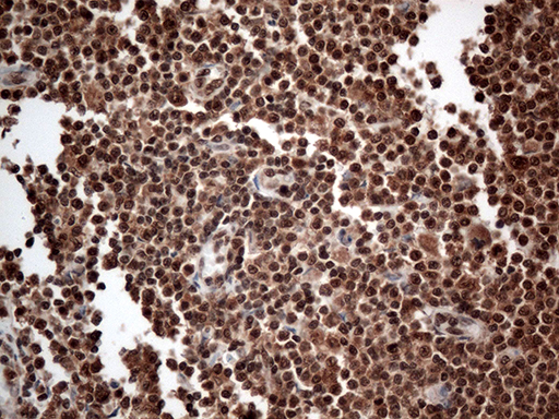 Immunohistochemical staining of paraffin-embedded Human lymphoma tissue using anti-CDK15 mouse monoclonal antibody