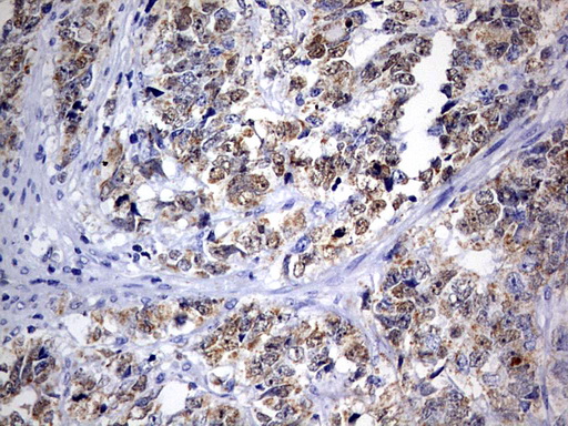 Immunohistochemical staining of paraffin-embedded Adenocarcinoma of Human endometrium tissue using anti-OXSM mouse monoclonal antibody