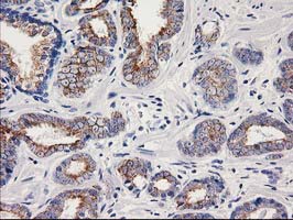 Immunohistochemical staining of paraffin-embedded Carcinoma of Human prostate tissue using anti-OSGEP mouse monoclonal antibody