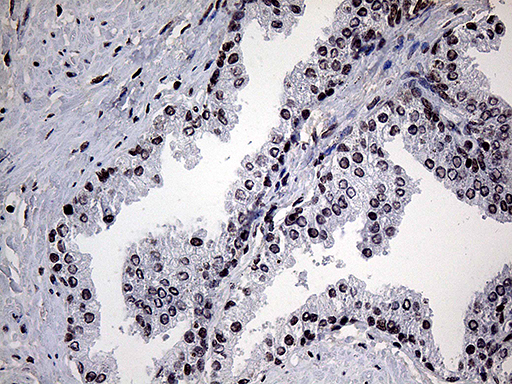 Immunohistochemical staining of paraffin-embedded Carcinoma of Human prostate tissue using anti-POLR3H mouse monoclonal antibody