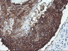 Immunohistochemical staining of paraffin-embedded Carcinoma of Human lung tissue using anti-SRPRB mouse monoclonal antibody
