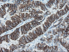 Immunohistochemical staining of paraffin-embedded Adenocarcinoma of Human ovary tissue using anti-SRPRB mouse monoclonal antibody