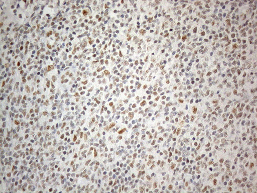Immunohistochemical staining of paraffin-embedded Human lymphoma tissue using anti-CWC27 mouse monoclonal antibody. (Heat-induced epitope retrieval by 1mM EDTA in 10mM Tris buffer (pH8.5) at 120°C for 3min Immunohistochemical staining of paraffin-embedded Human lymphoma tissue using anti-CWC27 mouse monoclonal antibody. (Heat-induced epitope retrieval by 1mM EDTA in 10mM Tris buffer (pH8.5) at 120°C for 3min
